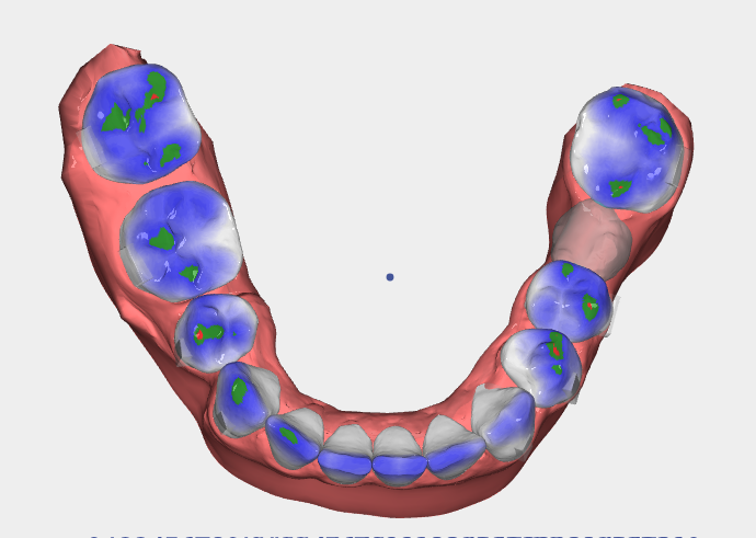 3D digital scan of a lower dental arch with colored markers on the teeth