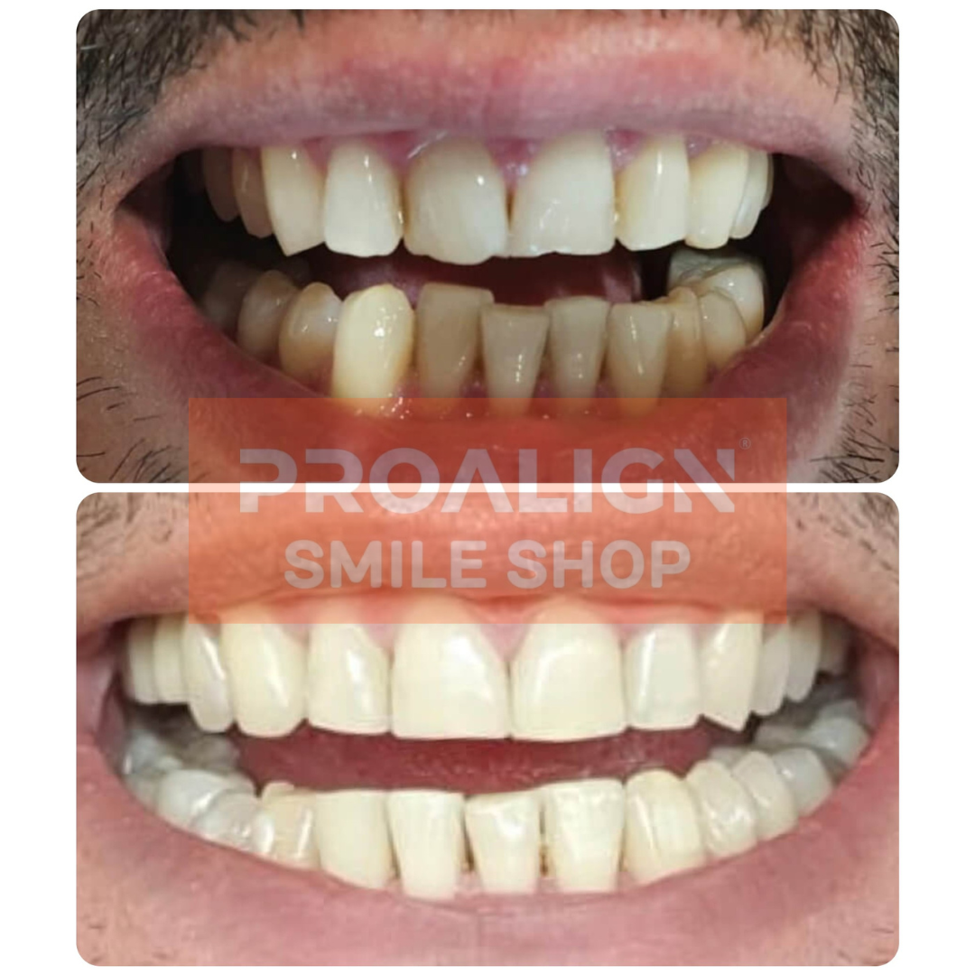 Patient's severe upper and lower crowding before and after 15 months of clear aligner treatment