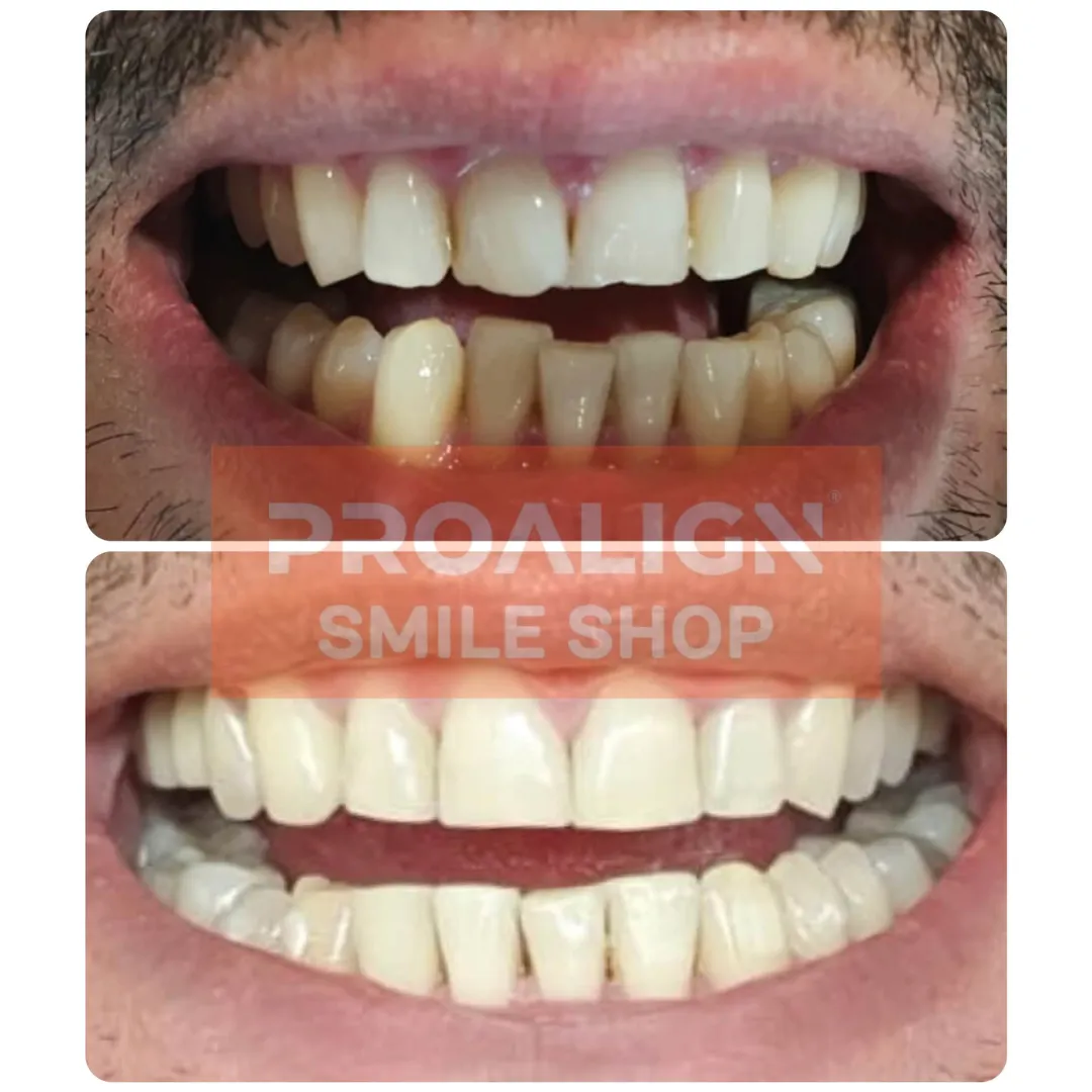 Patient's severe upper and lower crowding before and after 15 months of clear aligner treatment