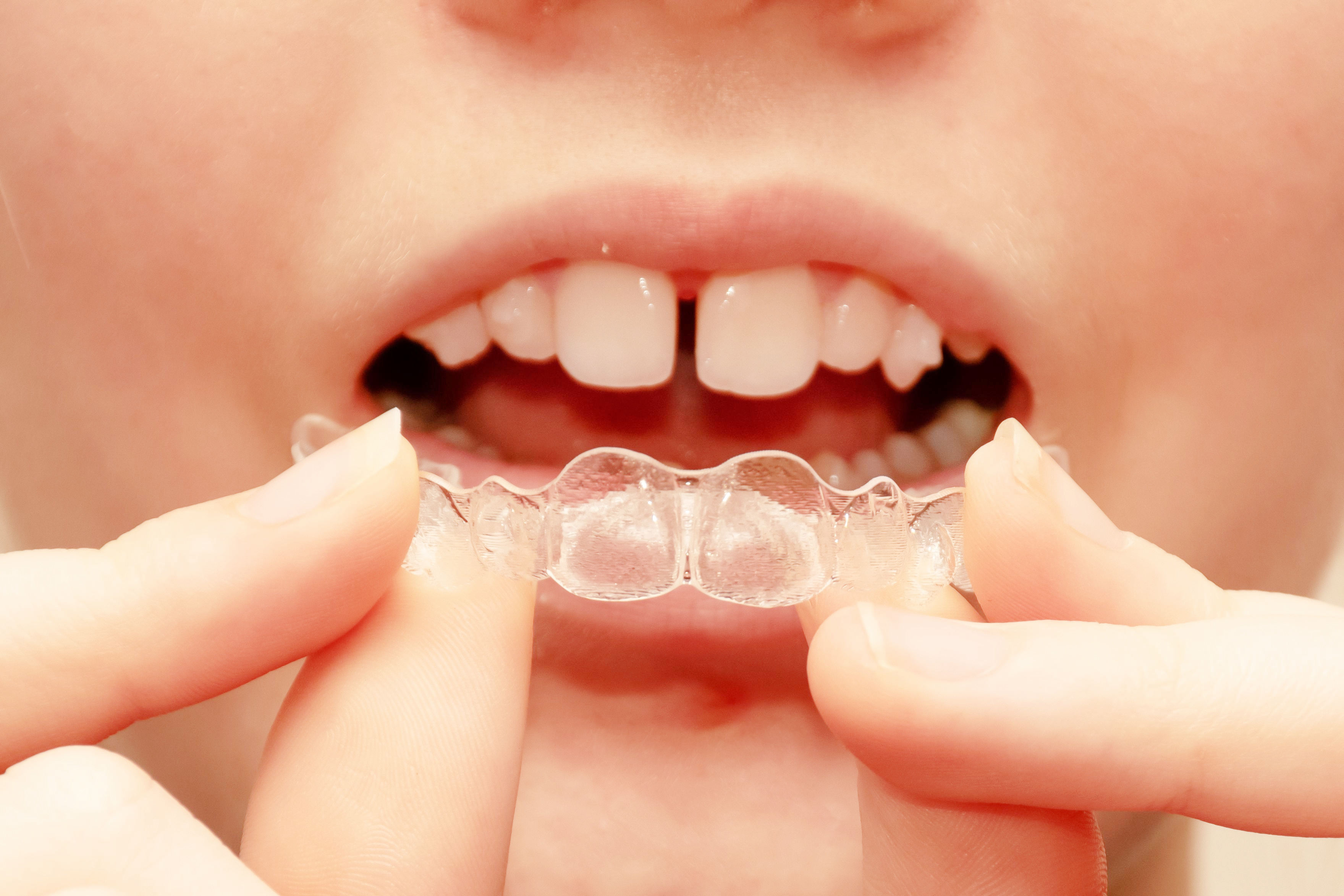 Patient with a gap between the front teeth holding a clear aligner