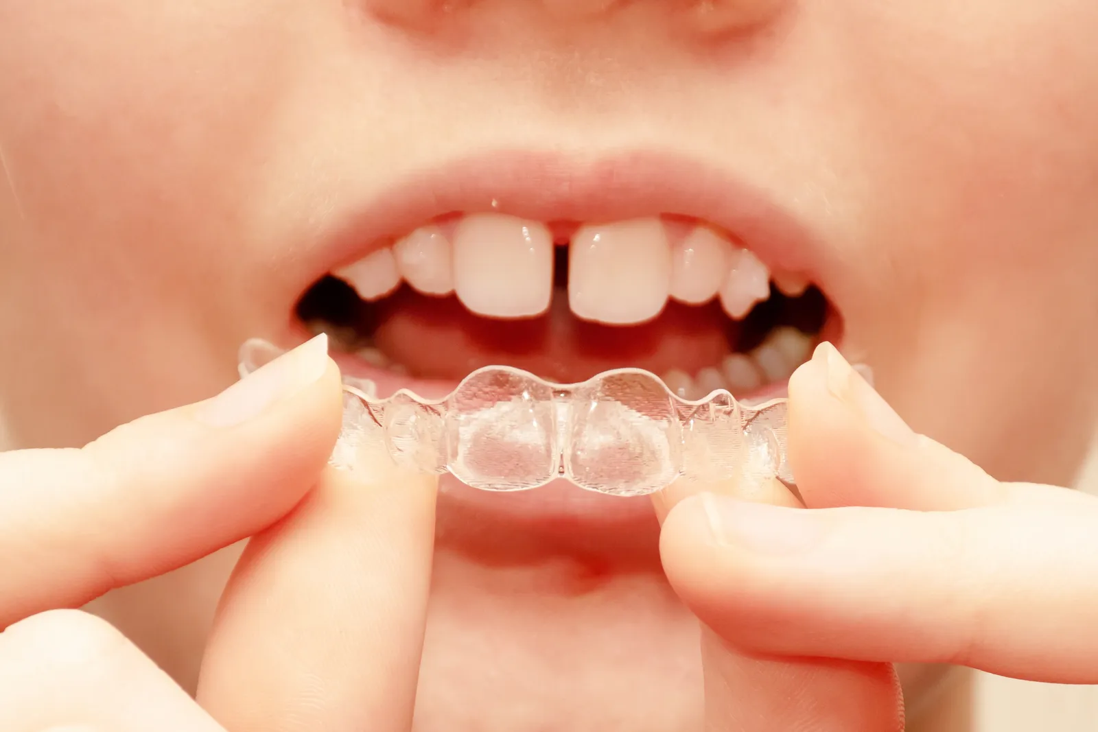 Patient with a gap between the front teeth holding a clear aligner