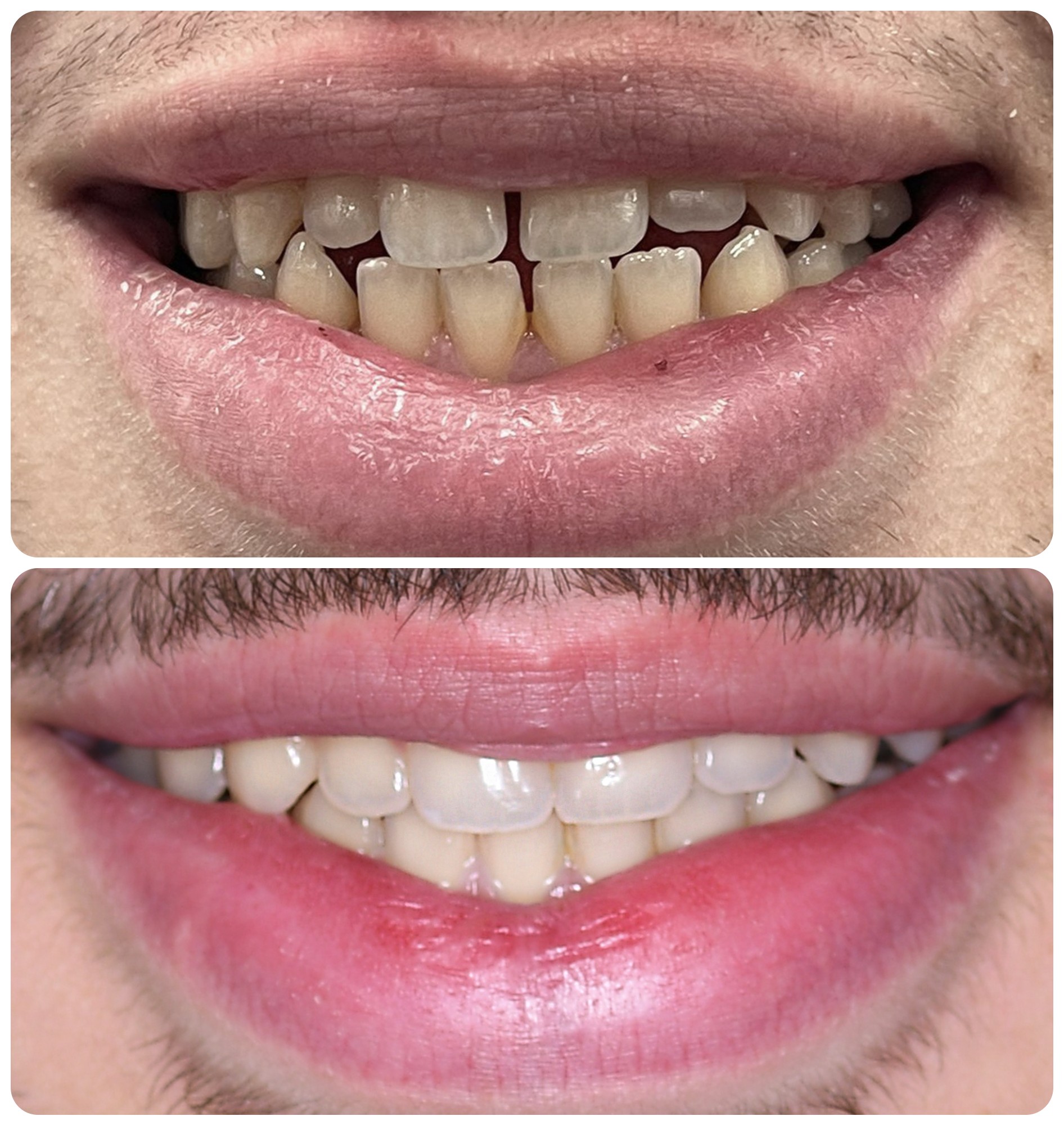 Before and after result for a patient with gapped teeth treated with clear aligners