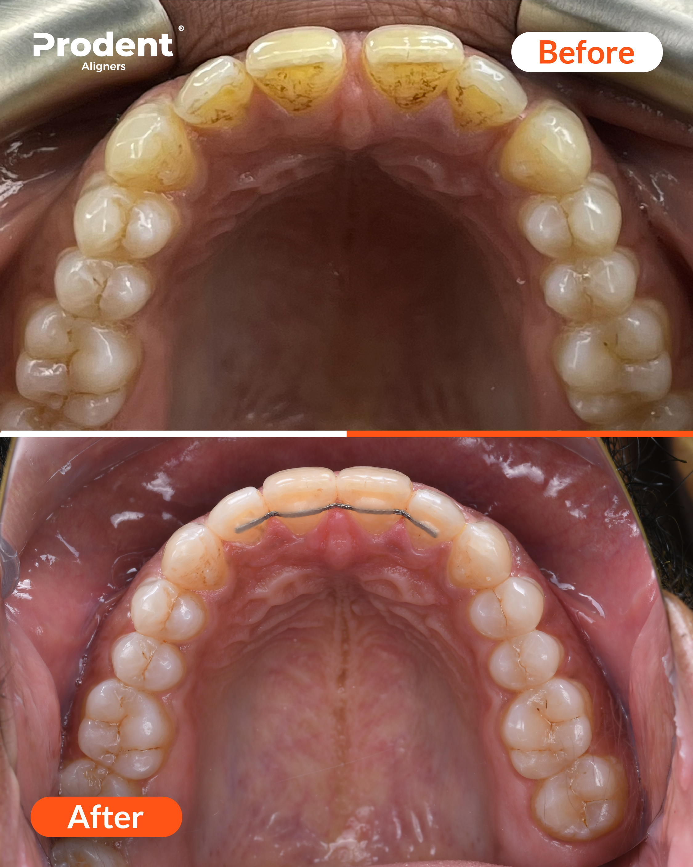 Before and after clear-aligner result for a patient treated at Proalign Smile Shop