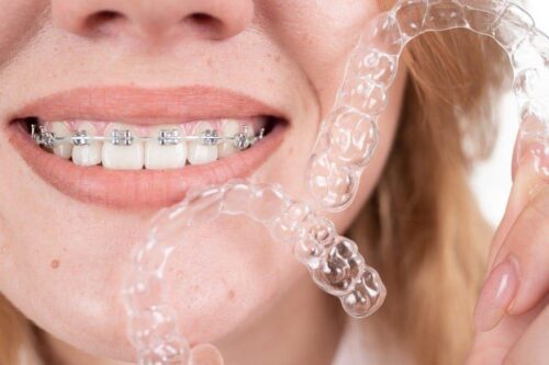 Patient smiling during clear aligner treatment