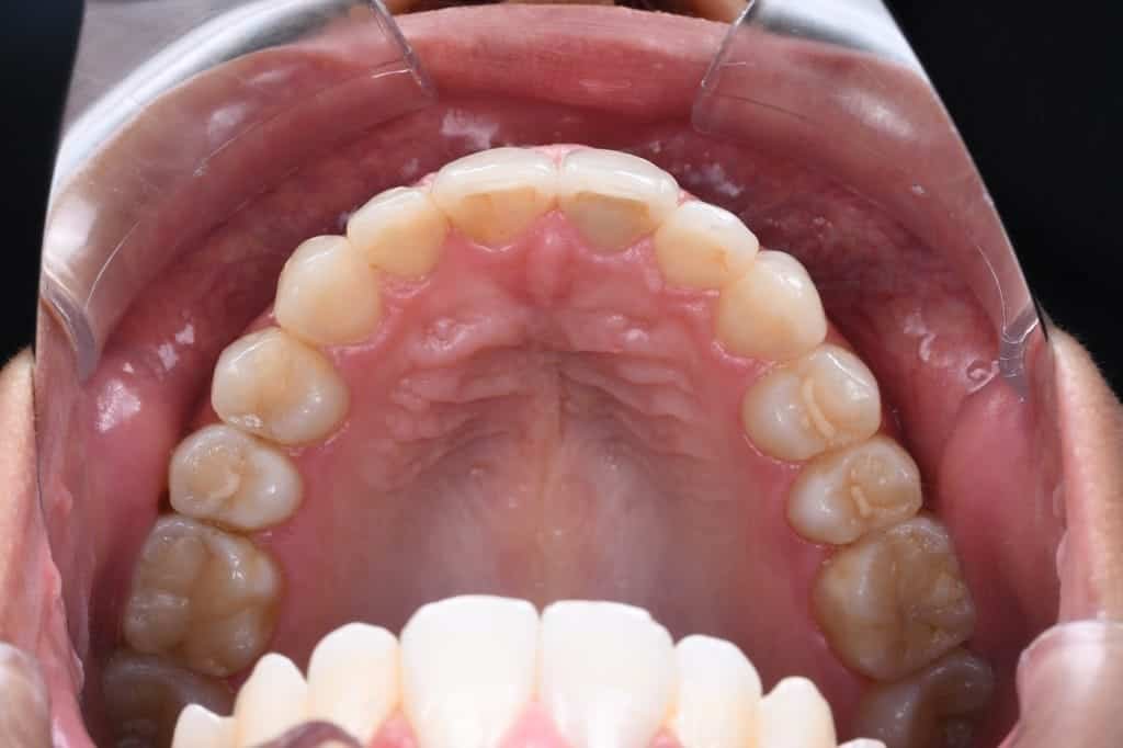 After Invisalign treatment, front teeth