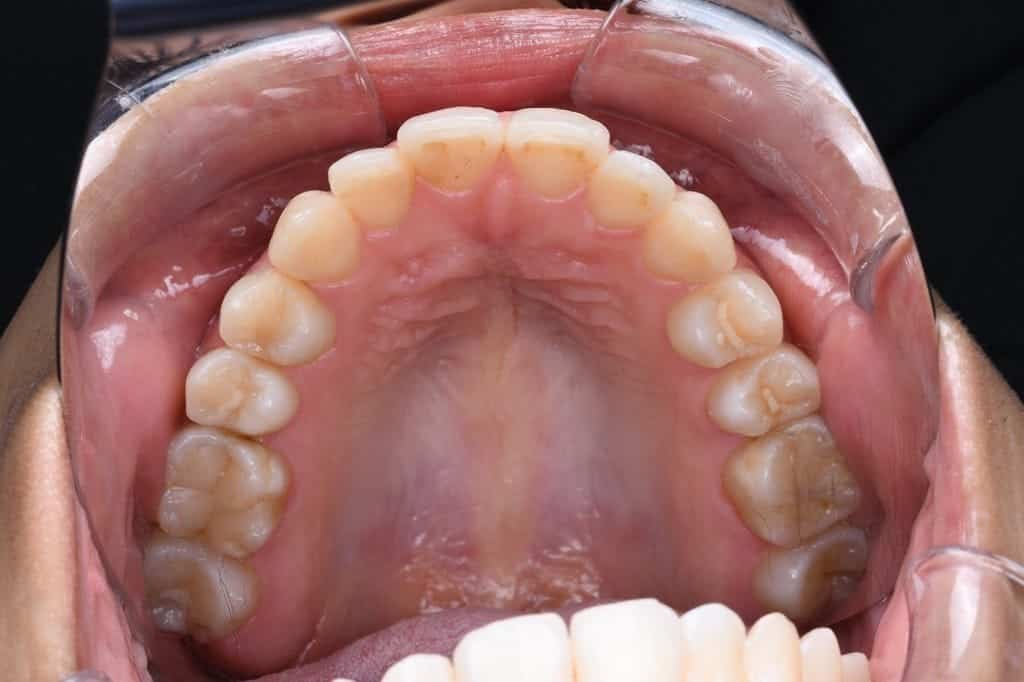 Before Invisalign treatment, front teeth