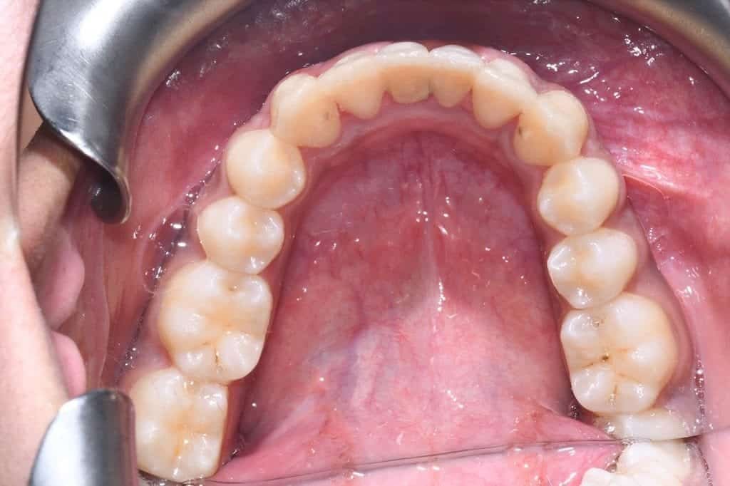 After Invisalign treatment, lower teeth