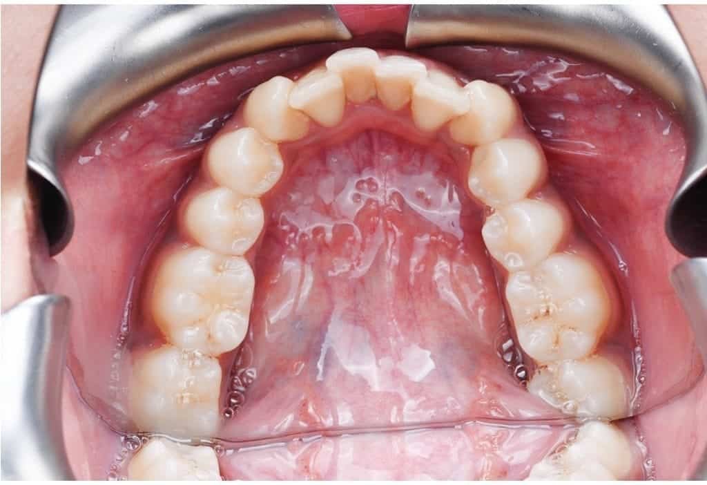 Before Invisalign treatment, lower teeth
