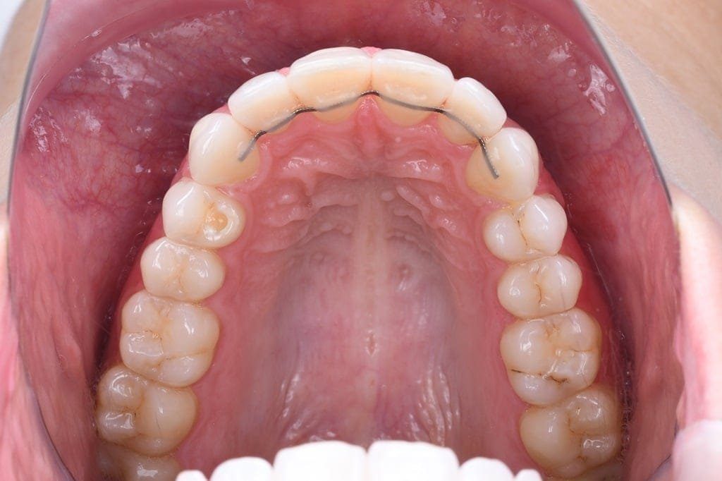 After Invisalign treatment, patient smile