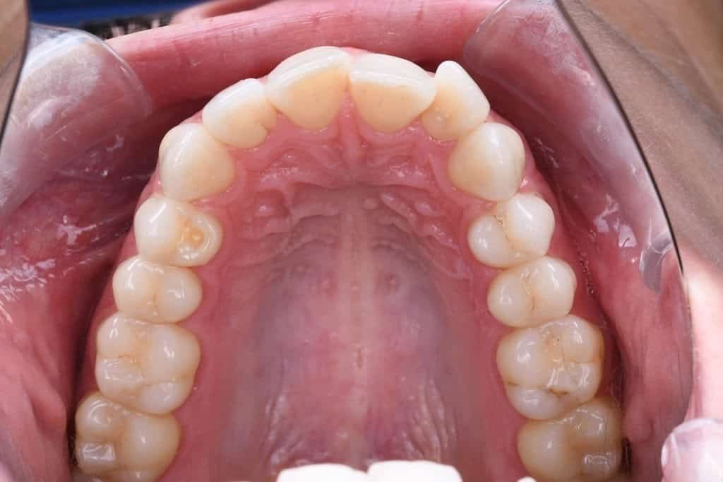 Before Invisalign treatment, patient smile