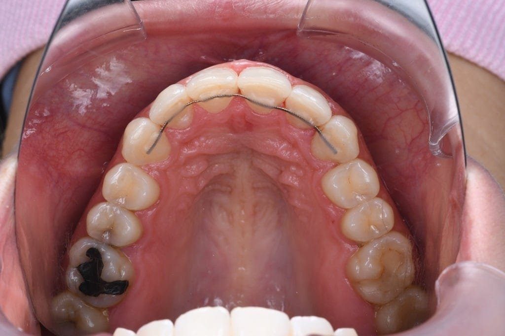 After Invisalign treatment, patient teeth