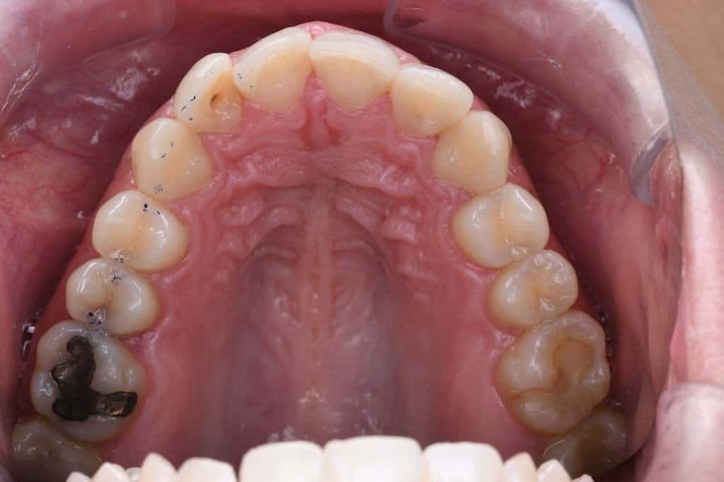 Before Invisalign treatment, patient teeth