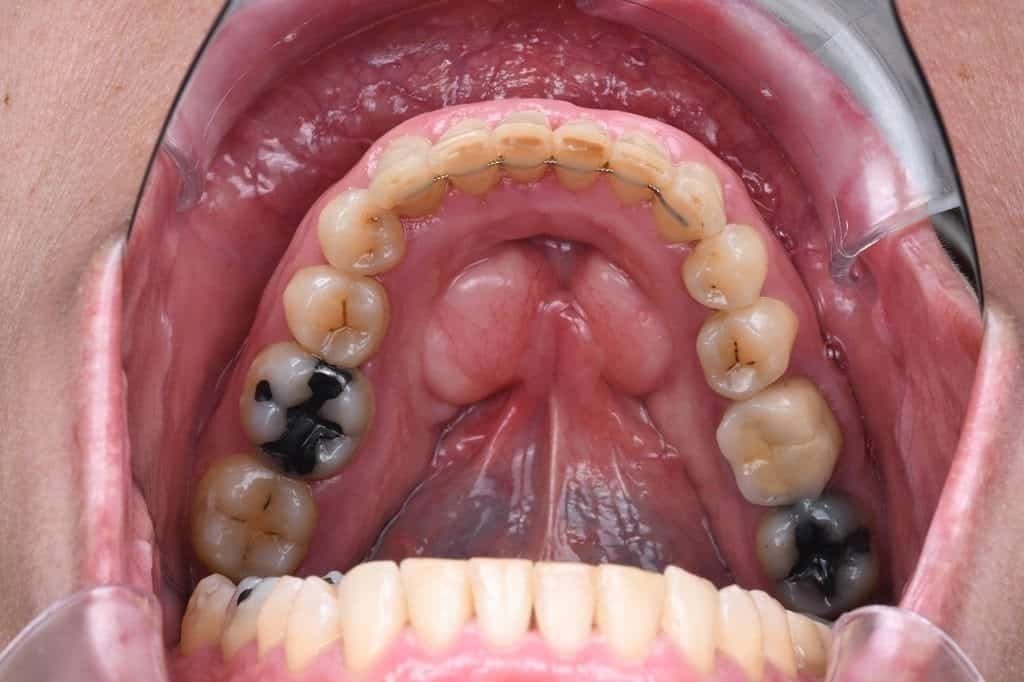 After Invisalign treatment, upper teeth