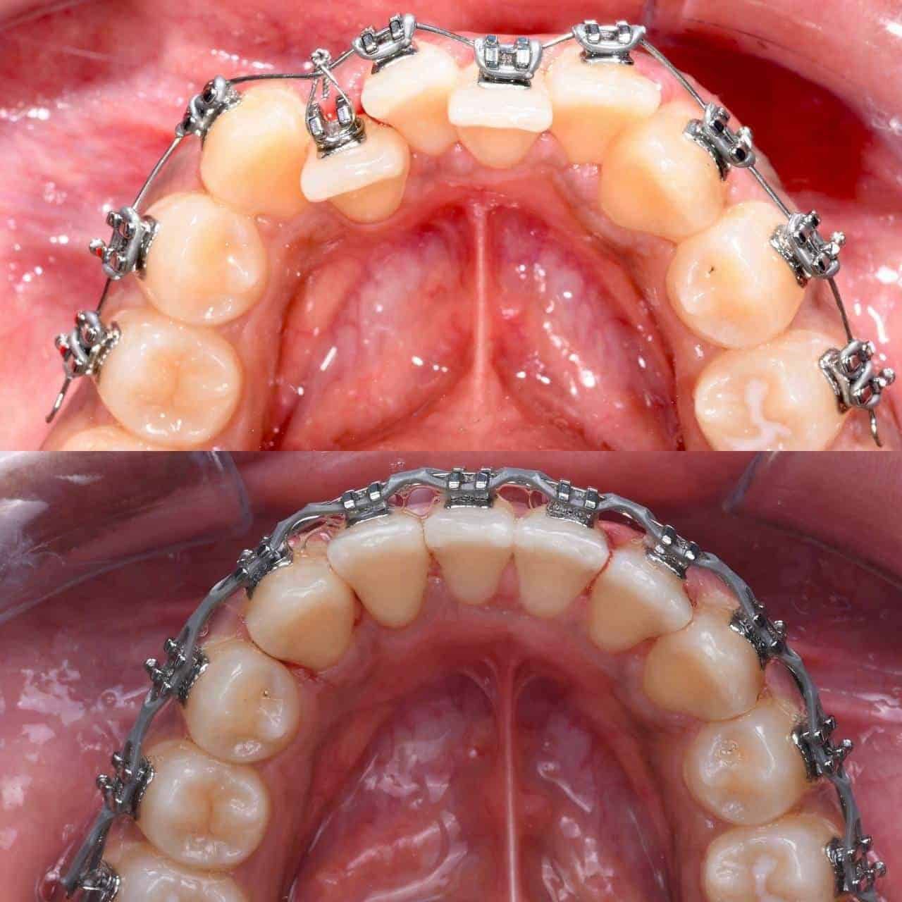 Metal braces before and after patient result 1 at ProAlign Smile Clinic in Dubai