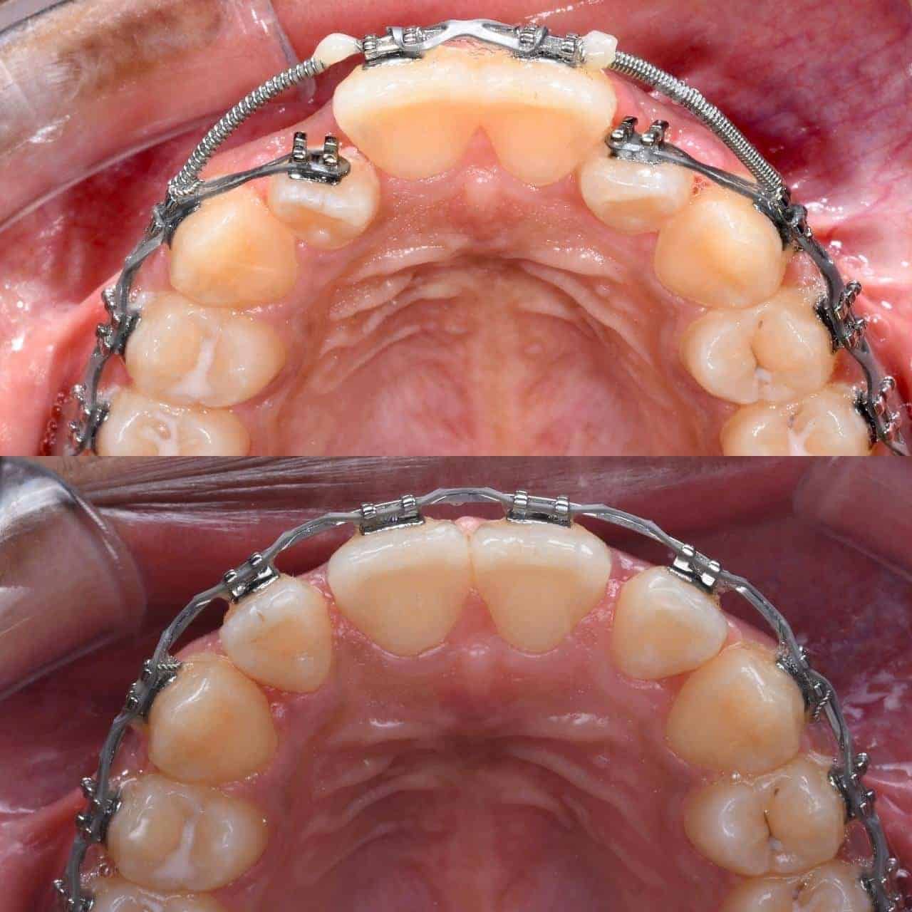 Metal braces before and after patient result 2 at ProAlign Smile Clinic in Dubai