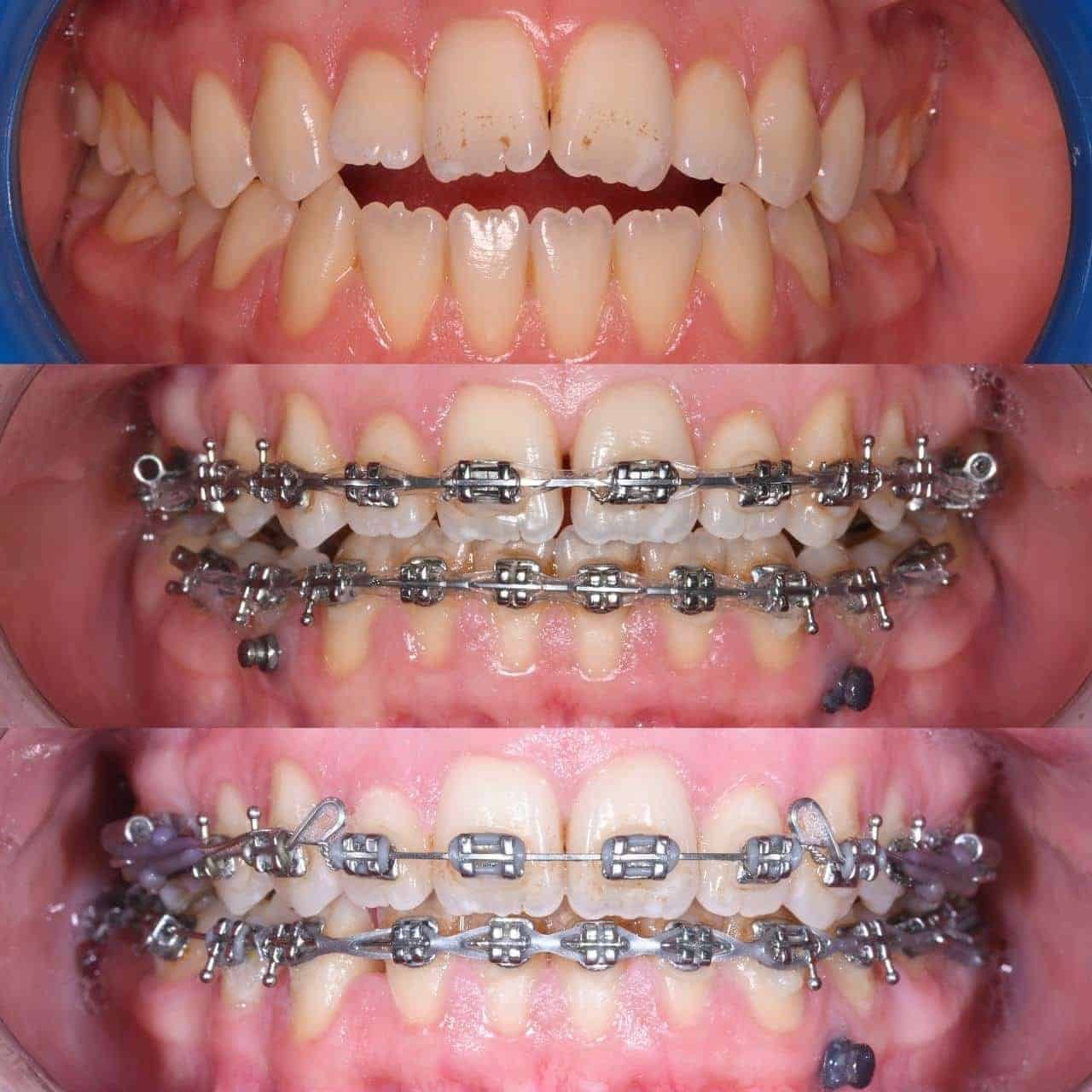 Metal braces before and after patient result 3 at ProAlign Smile Clinic in Dubai