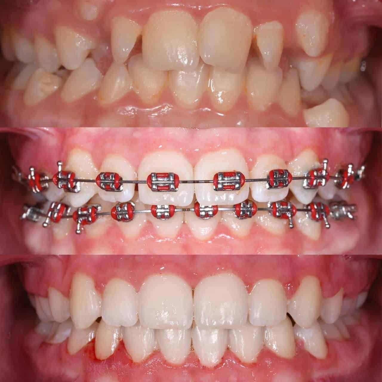 Metal braces before and after patient result 4 at ProAlign Smile Clinic in Dubai