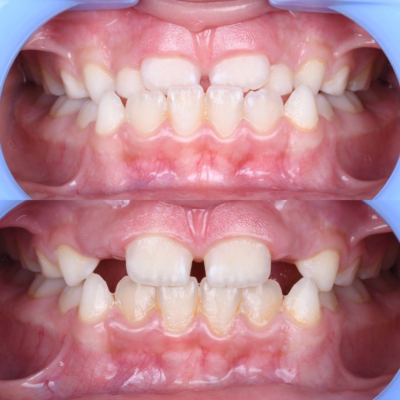 Metal braces before and after patient result 5 at ProAlign Smile Clinic in Dubai