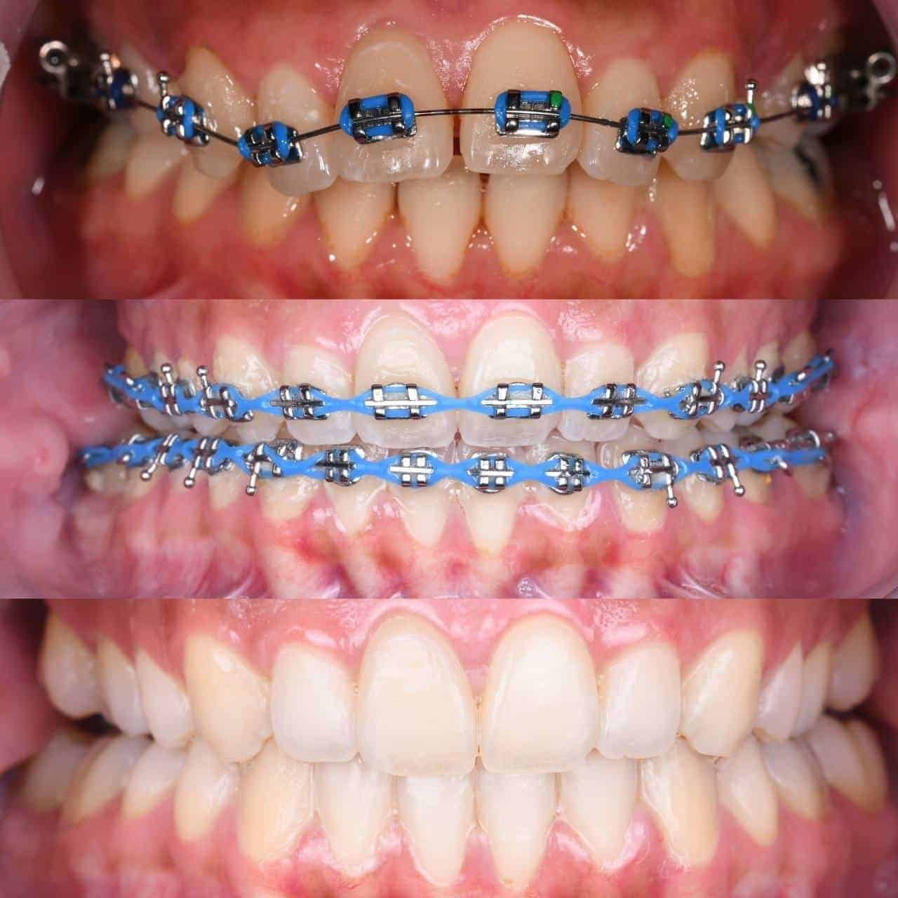 Metal braces before and after patient result 6 at ProAlign Smile Clinic in Dubai