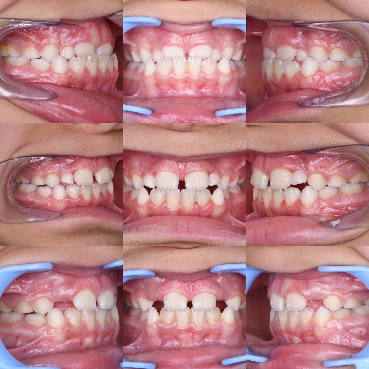 Metal braces before and after patient result 7 at ProAlign Smile Clinic in Dubai