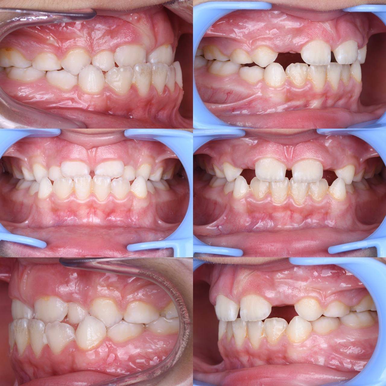 Metal braces before and after patient result 8 at ProAlign Smile Clinic in Dubai