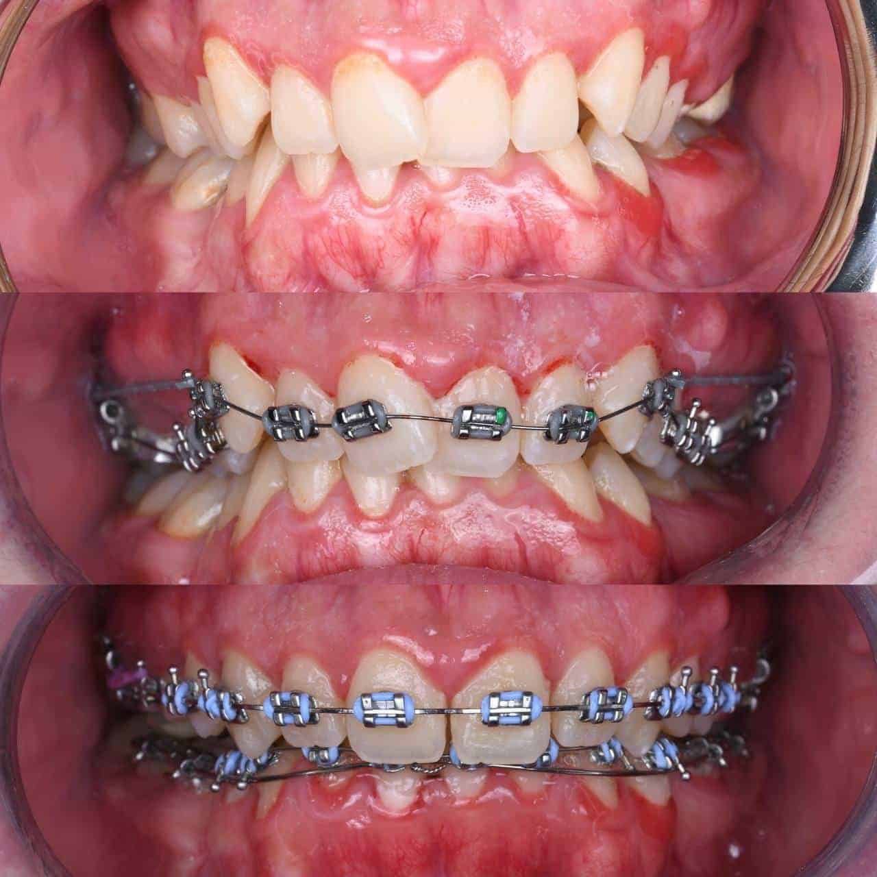 Metal braces before and after patient result 9 at ProAlign Smile Clinic in Dubai