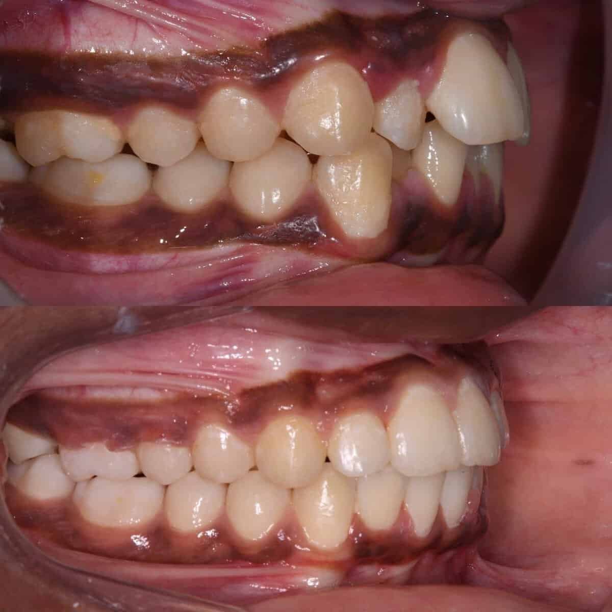 Metal braces before and after patient result 10 at ProAlign Smile Clinic in Dubai