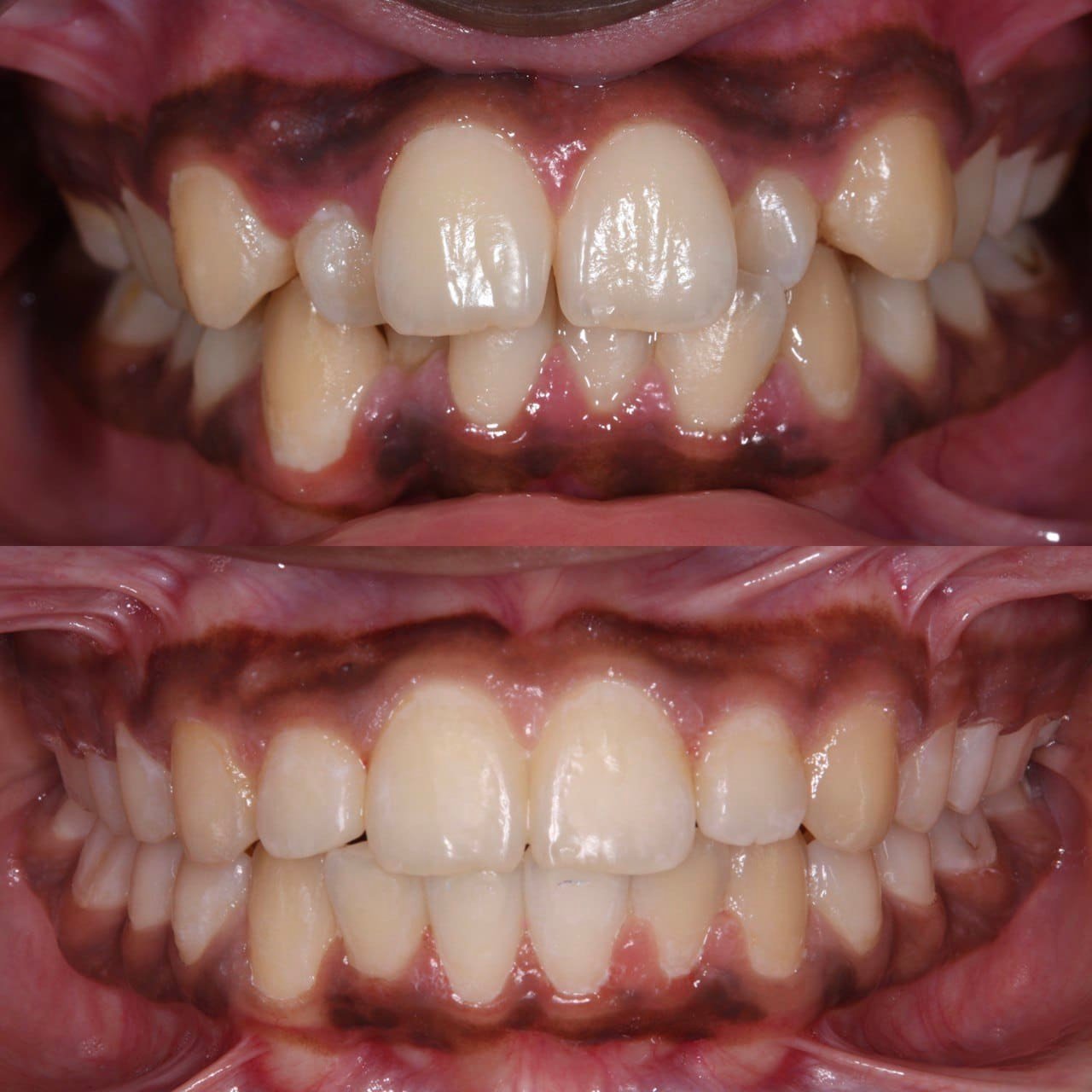 Metal braces before and after patient result 11 at ProAlign Smile Clinic in Dubai