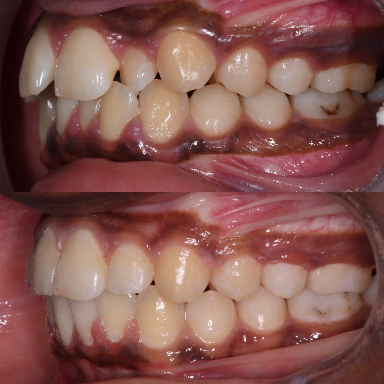 Metal braces before and after patient result 12 at ProAlign Smile Clinic in Dubai