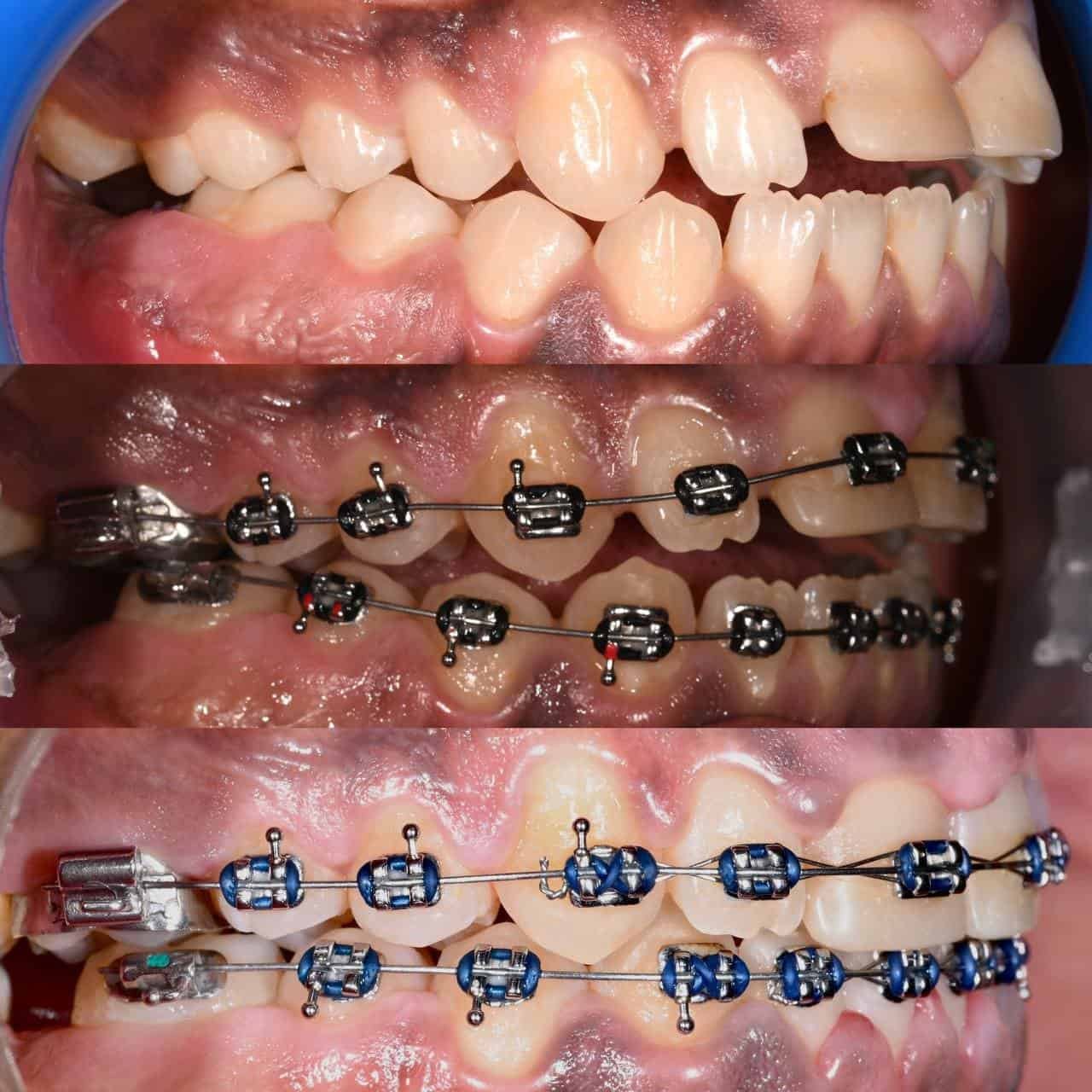 Metal braces before and after patient result 13 at ProAlign Smile Clinic in Dubai