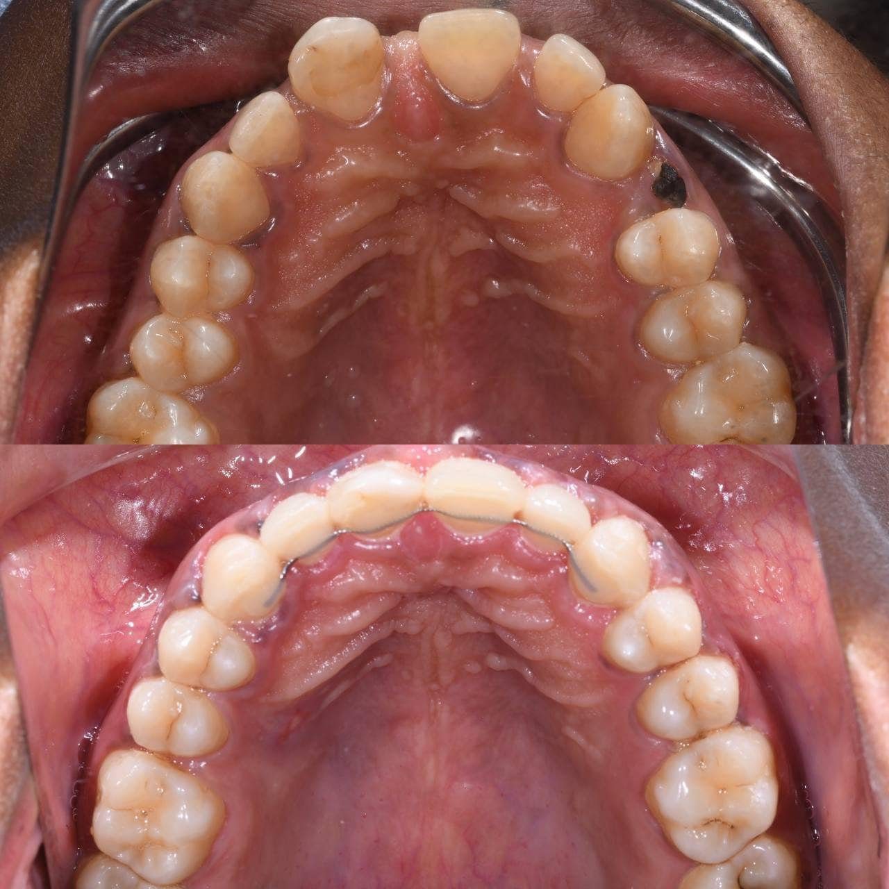 Metal braces before and after patient result 14 at ProAlign Smile Clinic in Dubai
