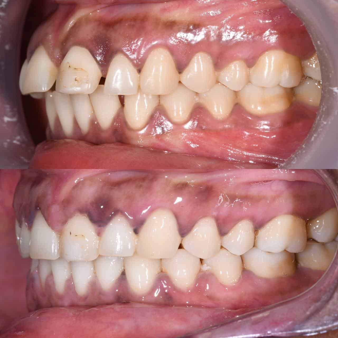 Metal braces before and after patient result 15 at ProAlign Smile Clinic in Dubai
