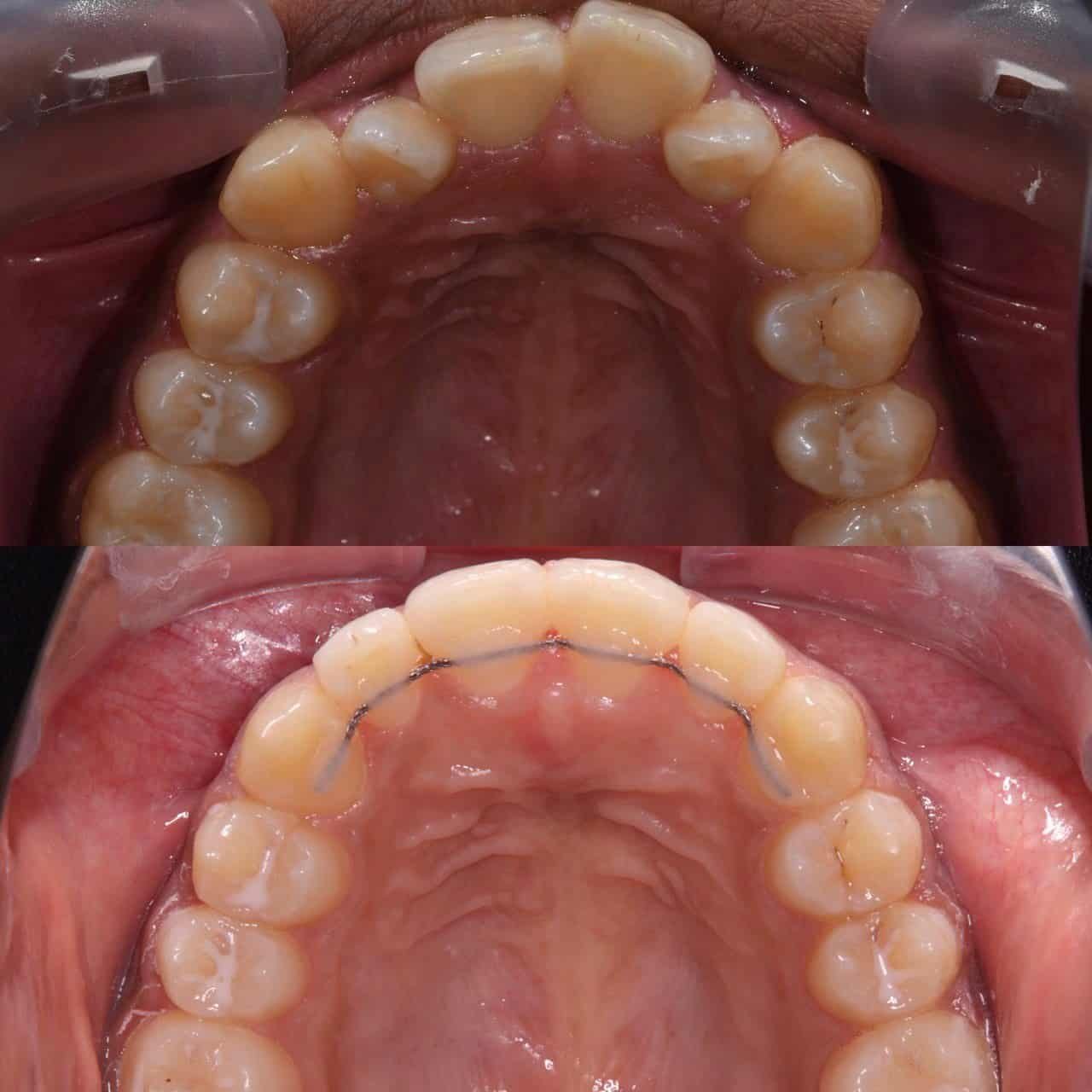Metal braces before and after patient result 16 at ProAlign Smile Clinic in Dubai