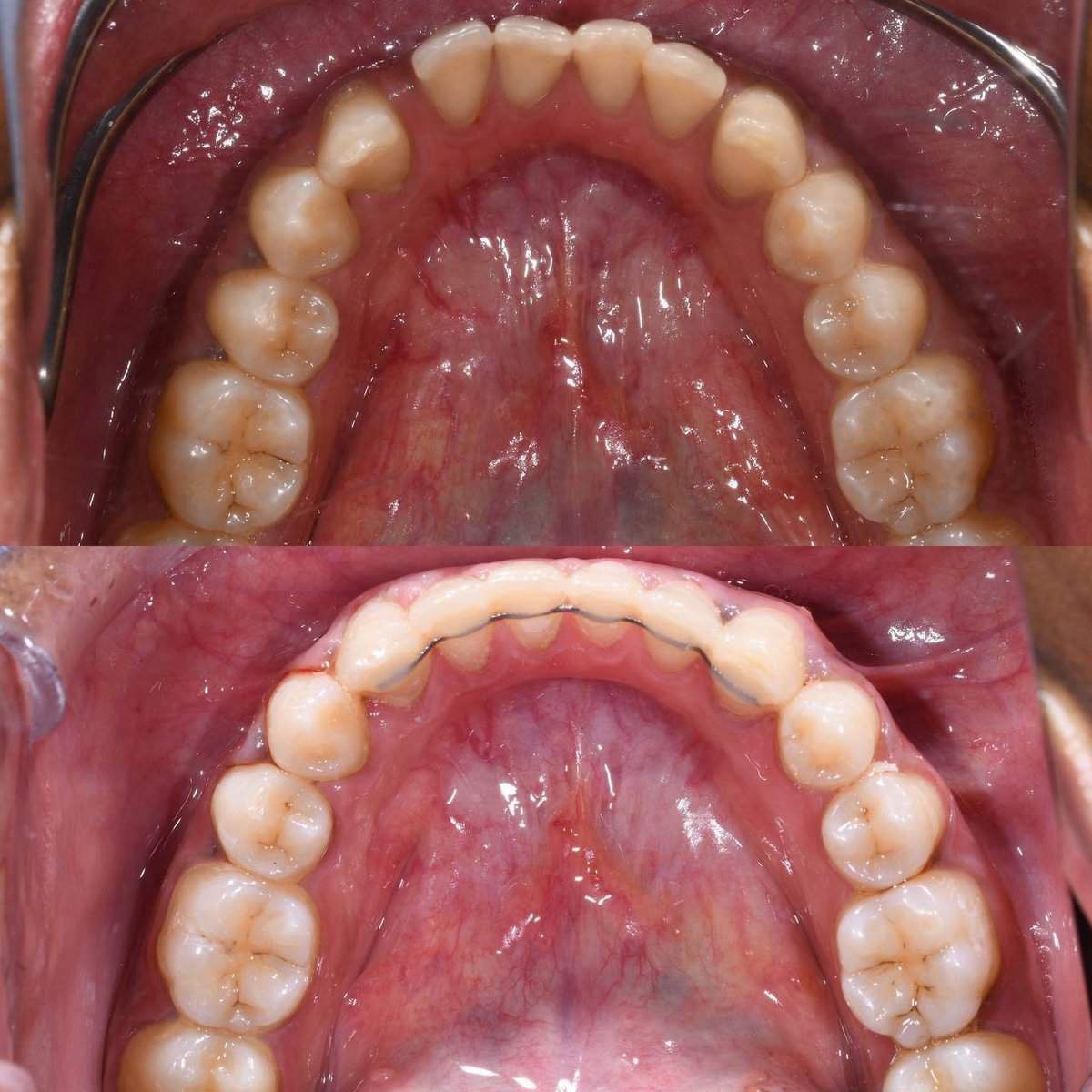 Metal braces before and after patient result 17 at ProAlign Smile Clinic in Dubai