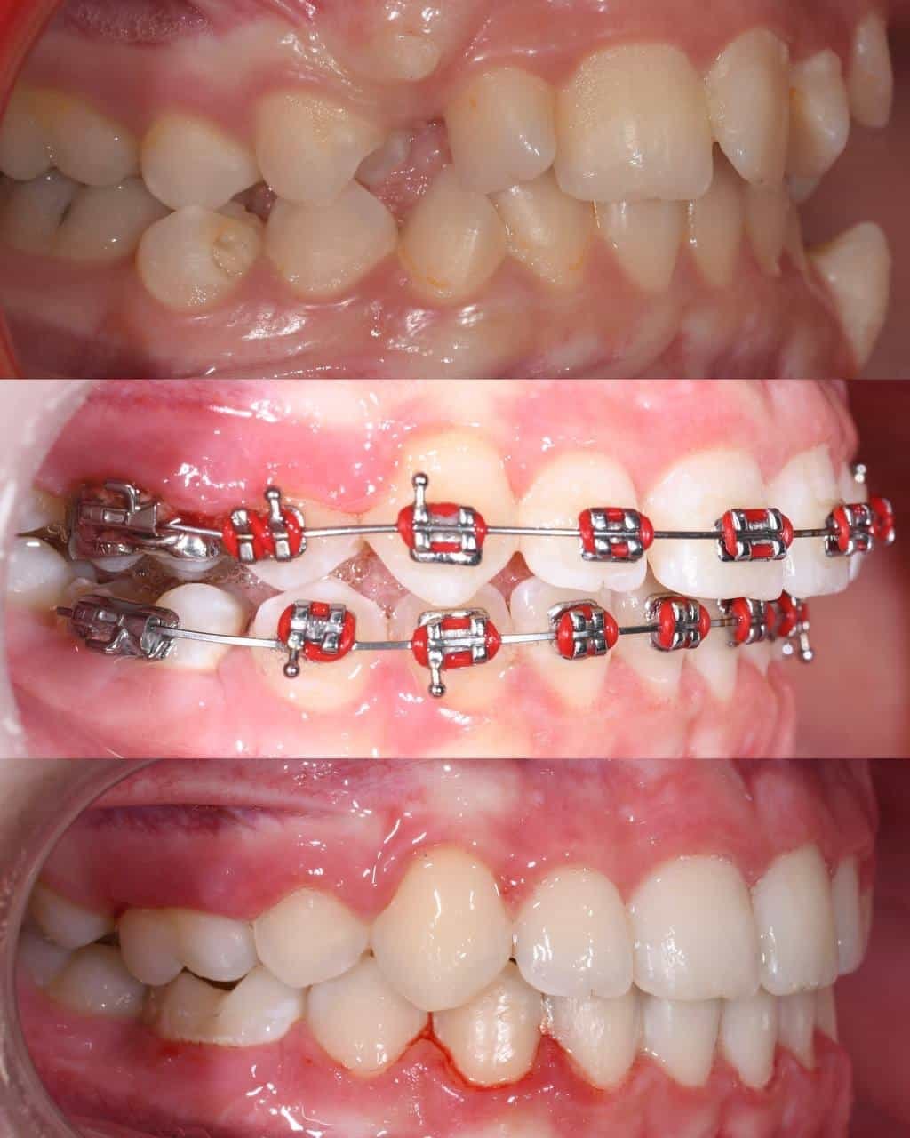 Metal braces before and after patient result 19 at ProAlign Smile Clinic in Dubai