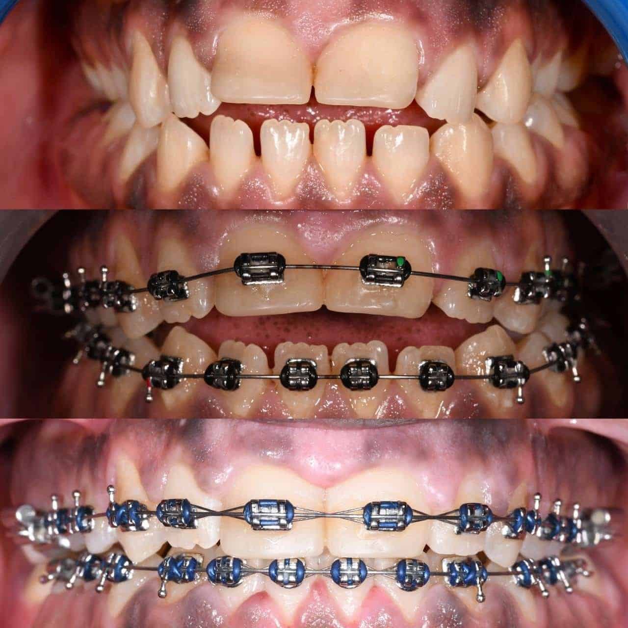 Metal braces before and after patient result 20 at ProAlign Smile Clinic in Dubai