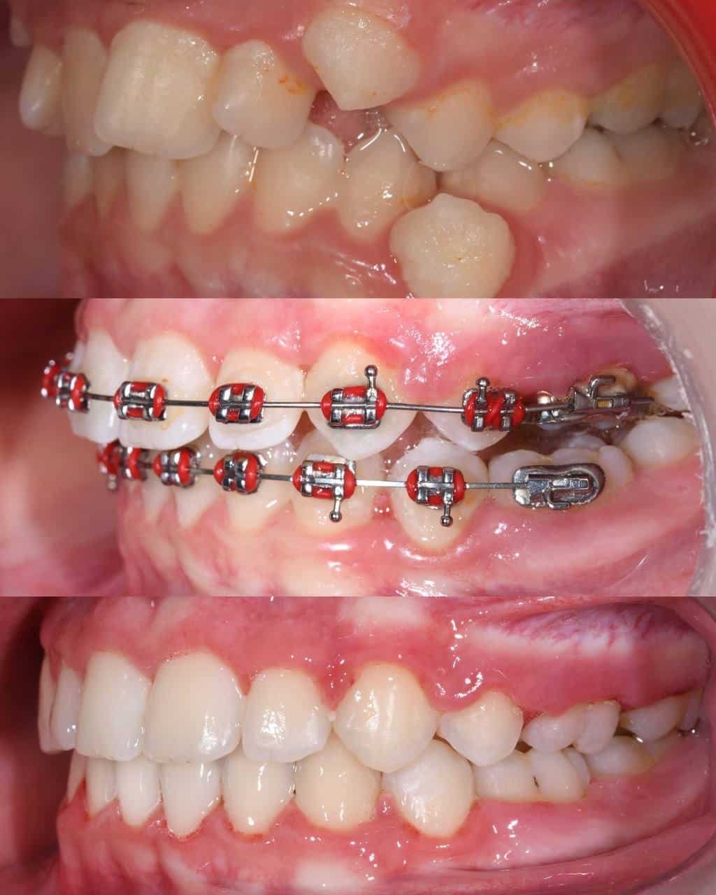 Metal braces before and after patient result 21 at ProAlign Smile Clinic in Dubai