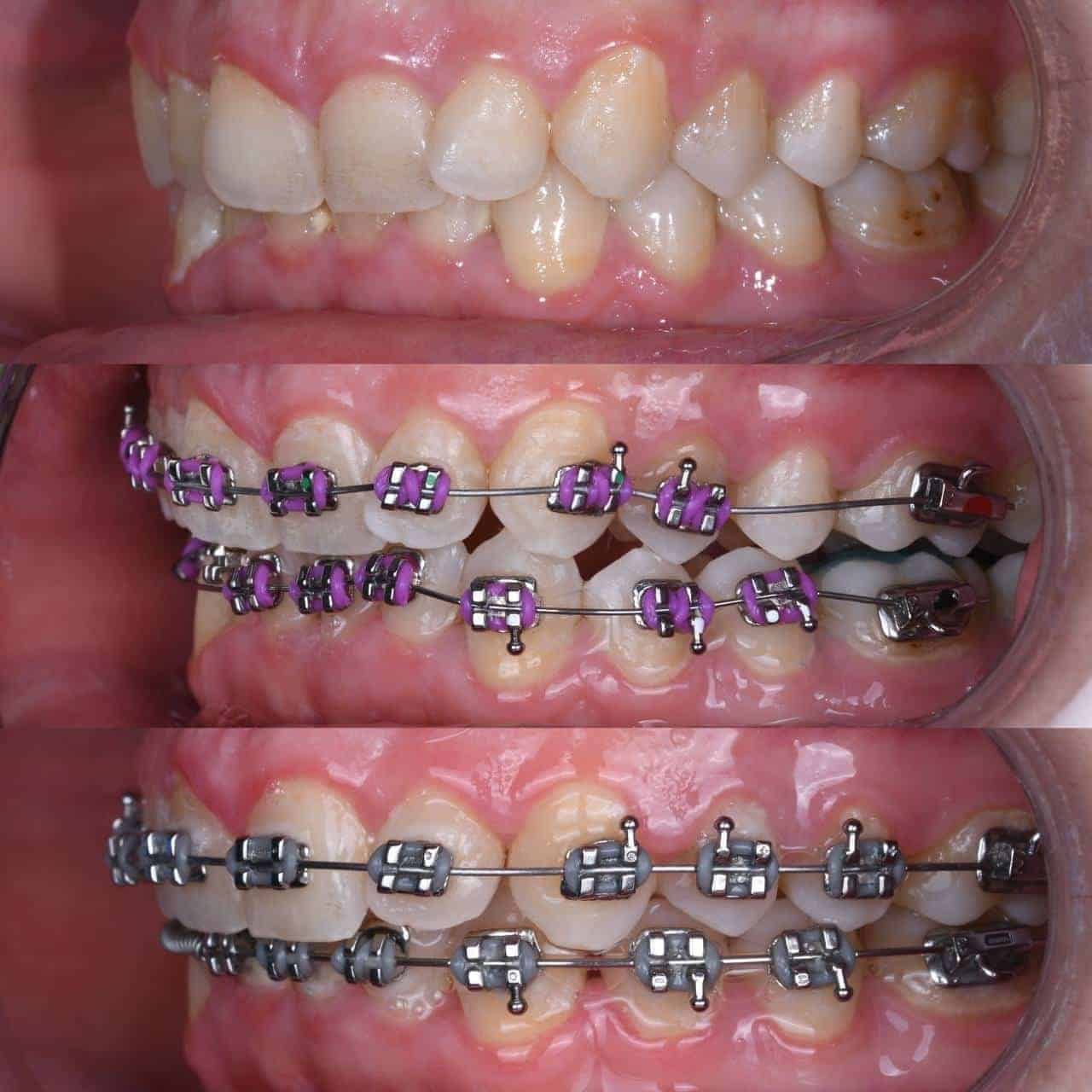Patient with metal braces during orthodontic treatment