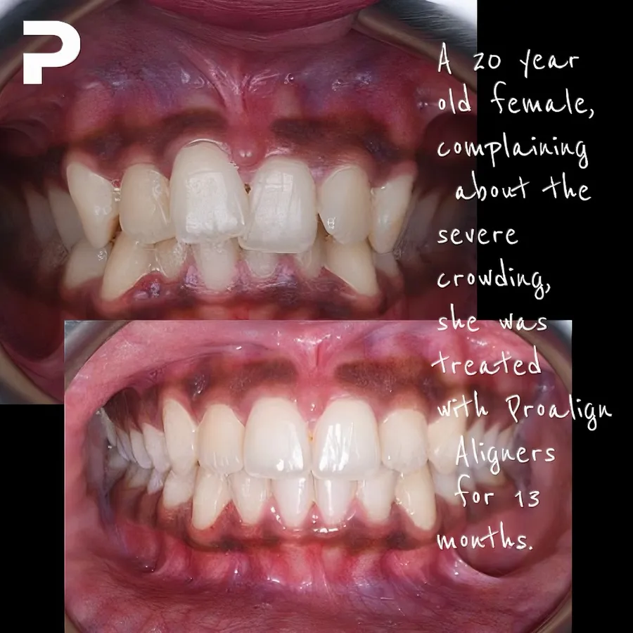 Crowded teeth before and after clear aligner treatment at Proalign Smile Shop