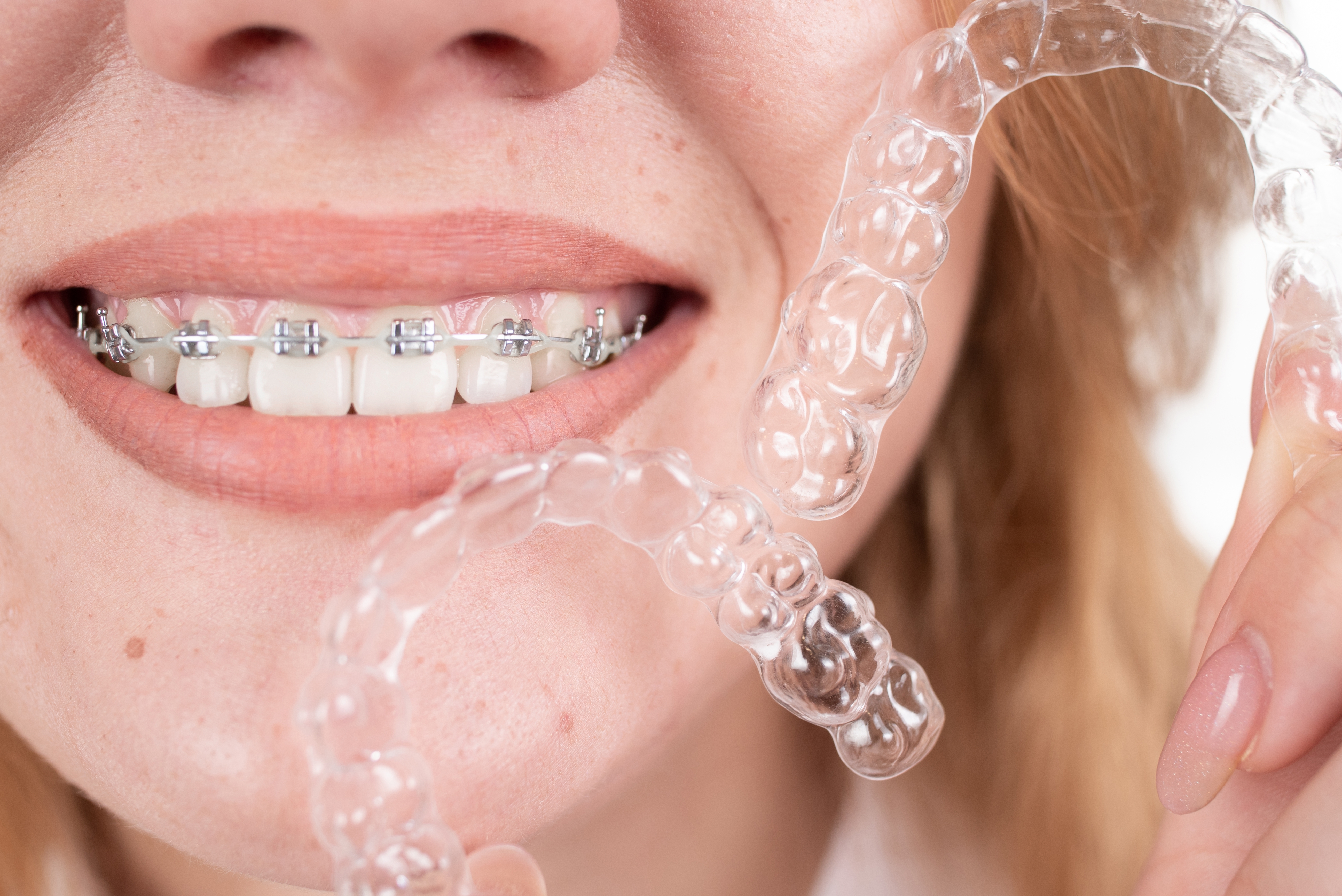 Close-up of a smile with braces beside a clear aligner