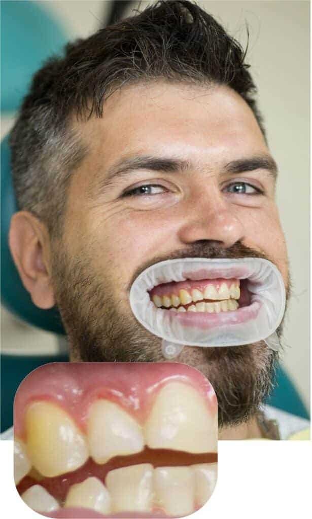 First professional teeth whitening patient result