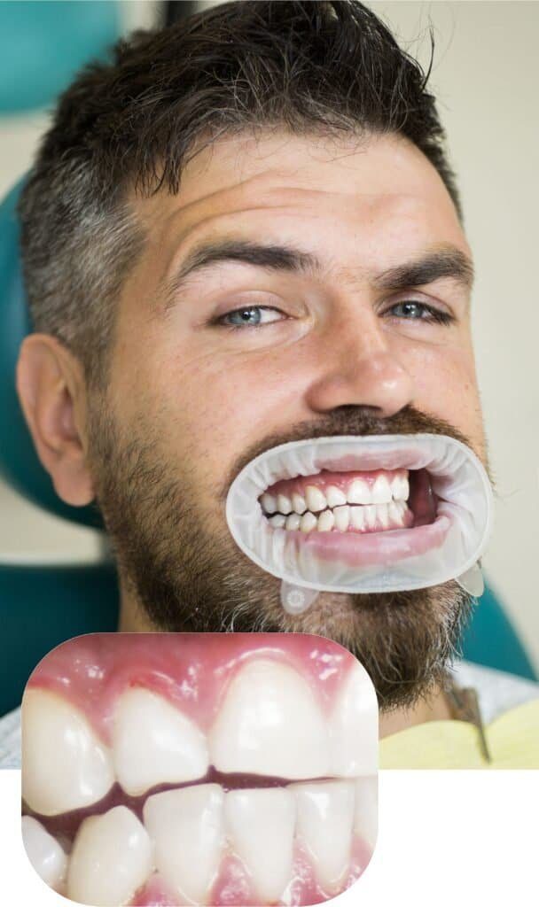 Second professional teeth whitening patient result