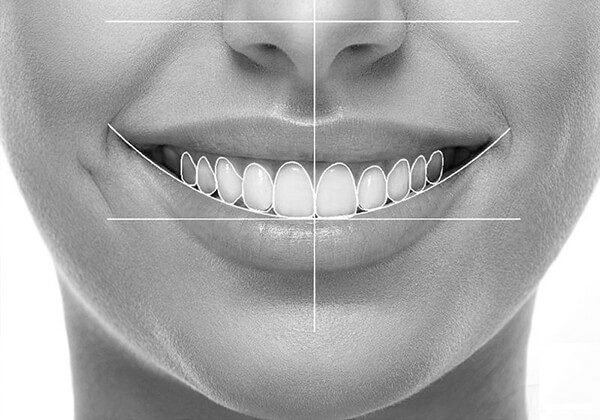 Smile design preview at Proalign