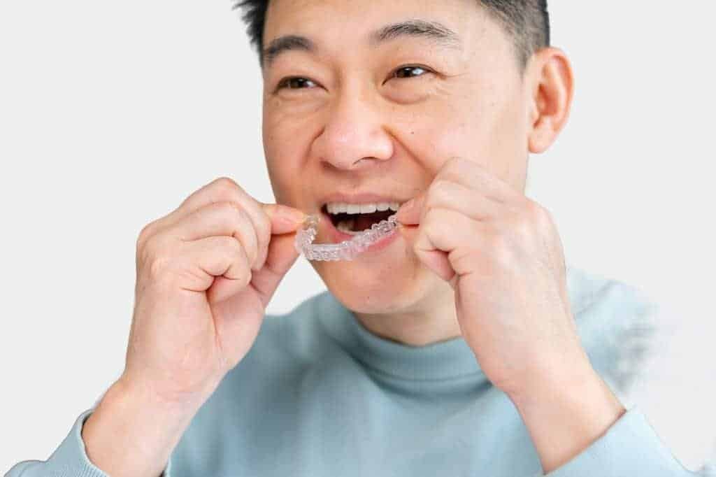 Invisalign clear aligners for Adult