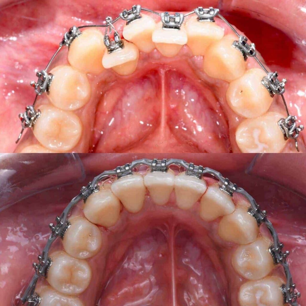 Braces case before and after clinic in dubai business bay
