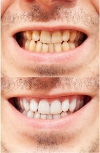 teeth whitening before and after results in dubai business bay