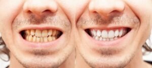 teeth whitening before and after in dubai