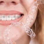 Clear Aligners in Dubai: Cost, Benefits, Treatment Time & Braces Comparison (2026 Guide) Person smiling with dental braces while holding a clear aligner tray, illustrating orthodontic treatment options like braces and Invisalign.