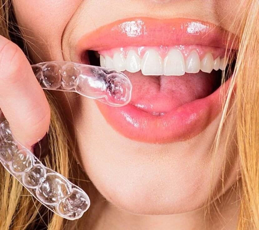 Proalign Smile Shop Clear Aligners