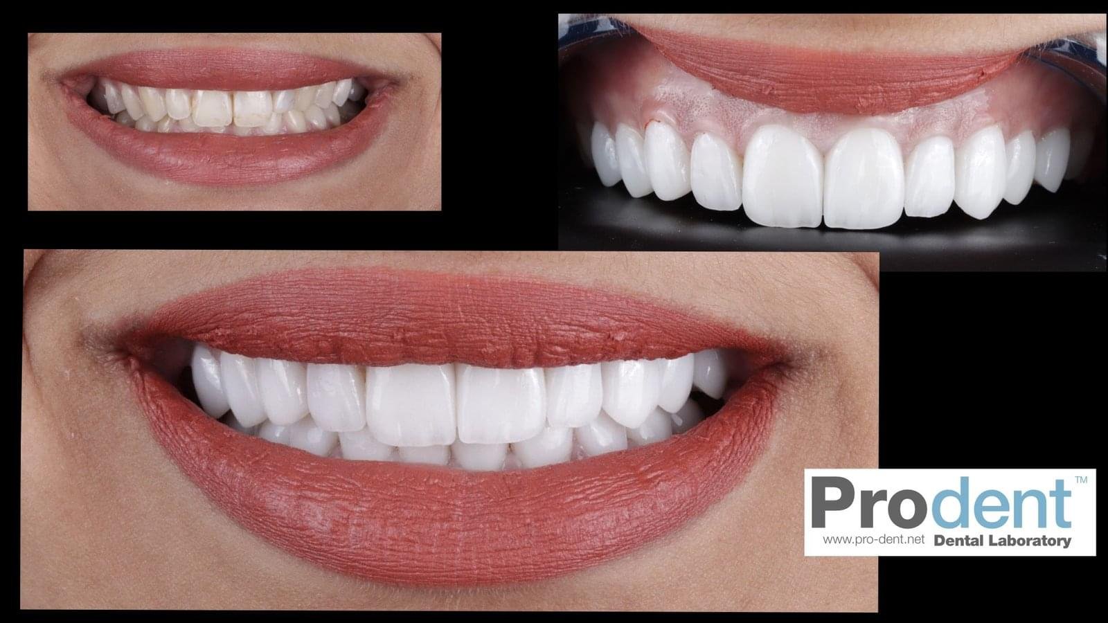Proalign Smile Design